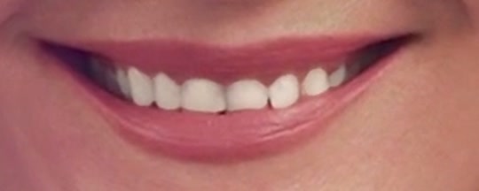 The same smile with fully whitened teeth