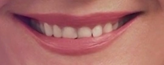 The same smile with lightly whitened teeth